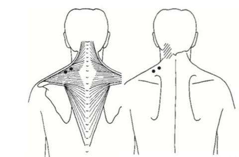 Trapezius trigger points