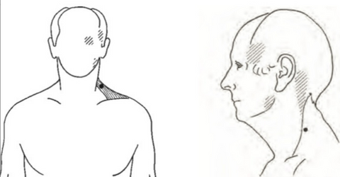 Scapularis trigger points