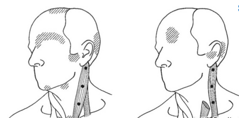 Sternocleidomastoid trigger point